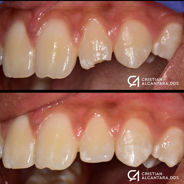 Chipped front tooth restored with a composite filling