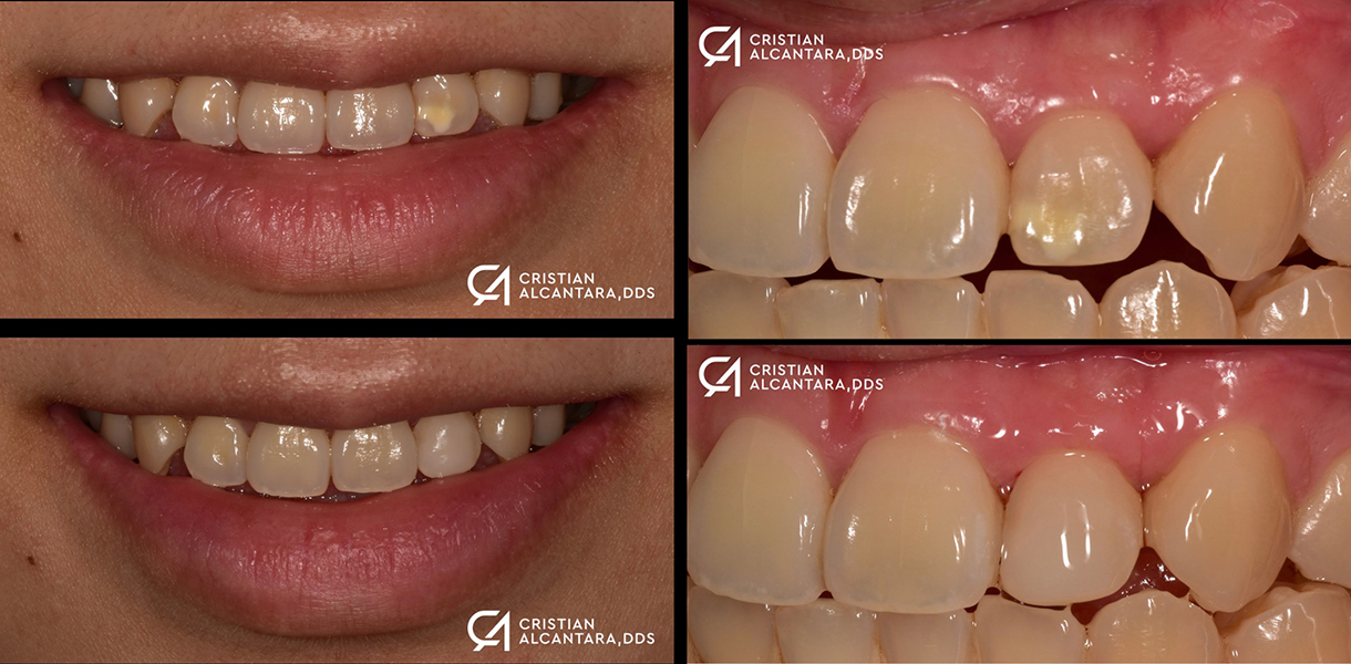 Smile enhancement - fixed decalcified enamel with a composite bonding