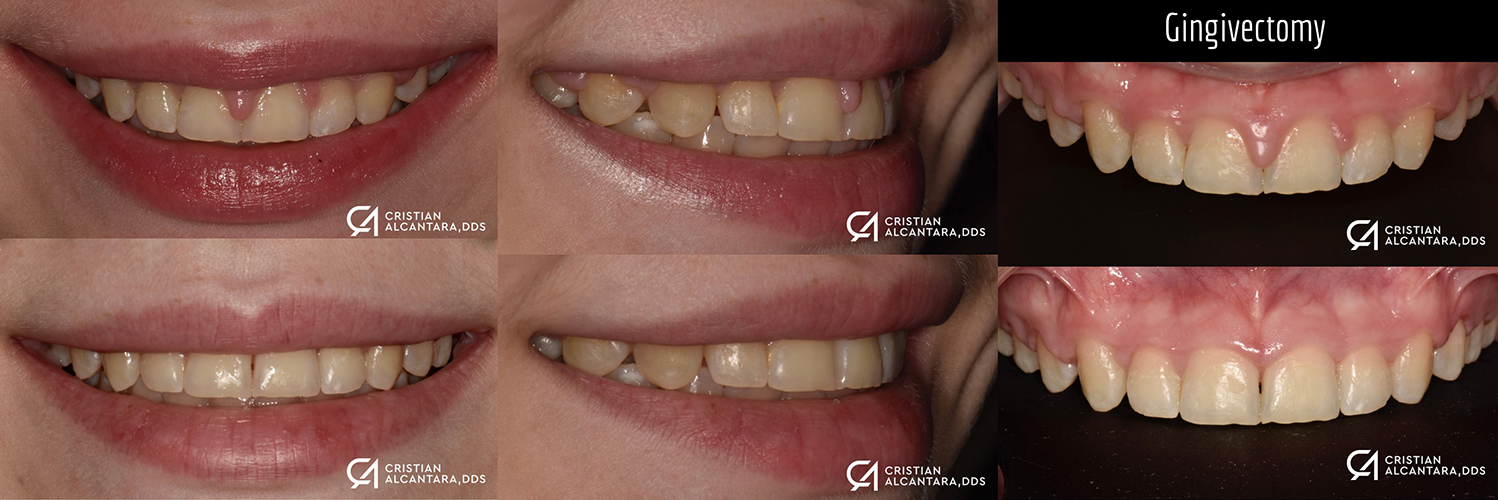 Gum recontouring with laser to remove gum growth after braces