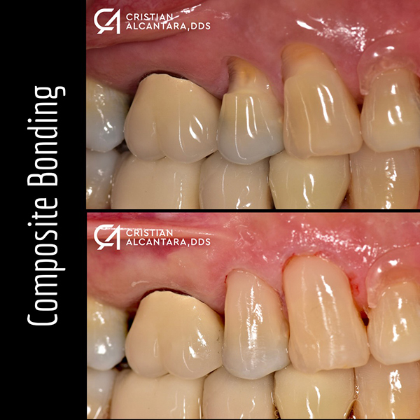 Chipped enamel at gumline area was fixed with cervical composite bondings