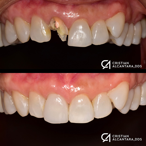 Broken front tooth restored with a single porcelain crown