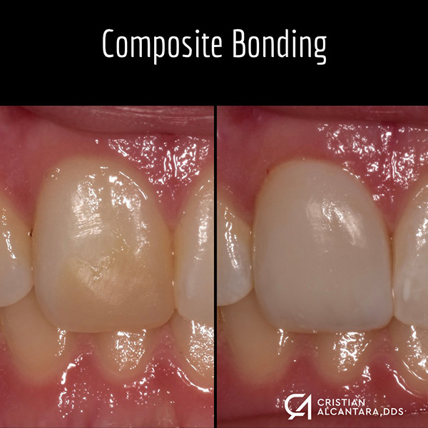 New Composite bonding replacing old, darkened filling