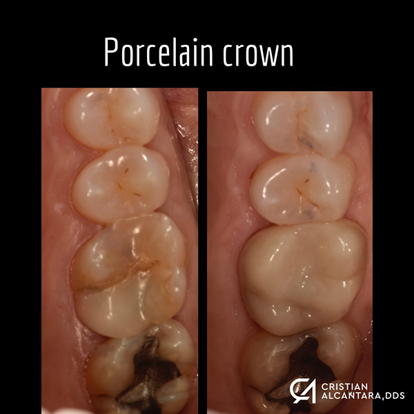Older, failing composite filling replaced with full coverage porcelain crown