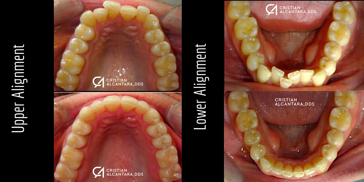 Invisalign treatment