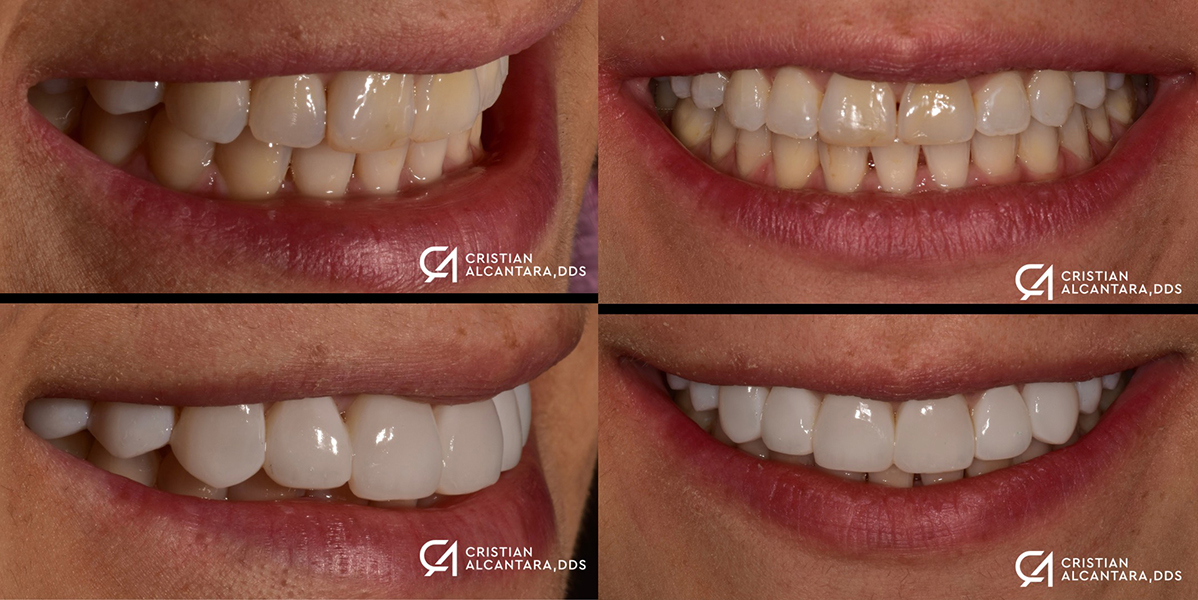 Smile enhancement with composite veneers