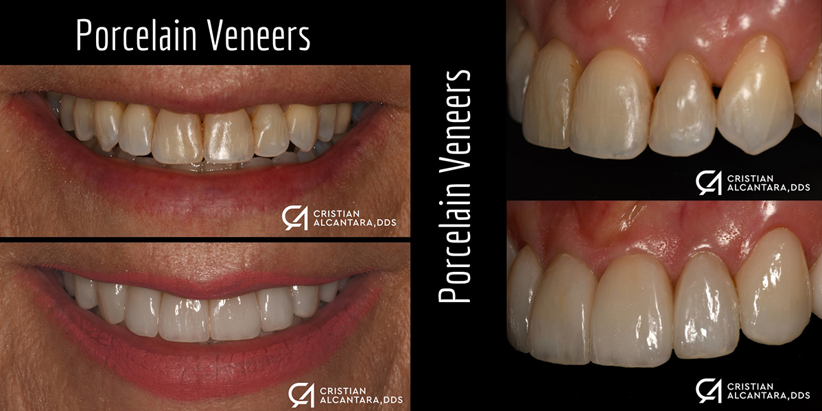 Smile makeover with porcelain veneers