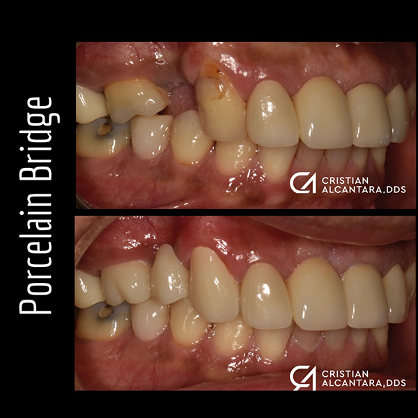 Replaced missing tooth with porcelain bridge
